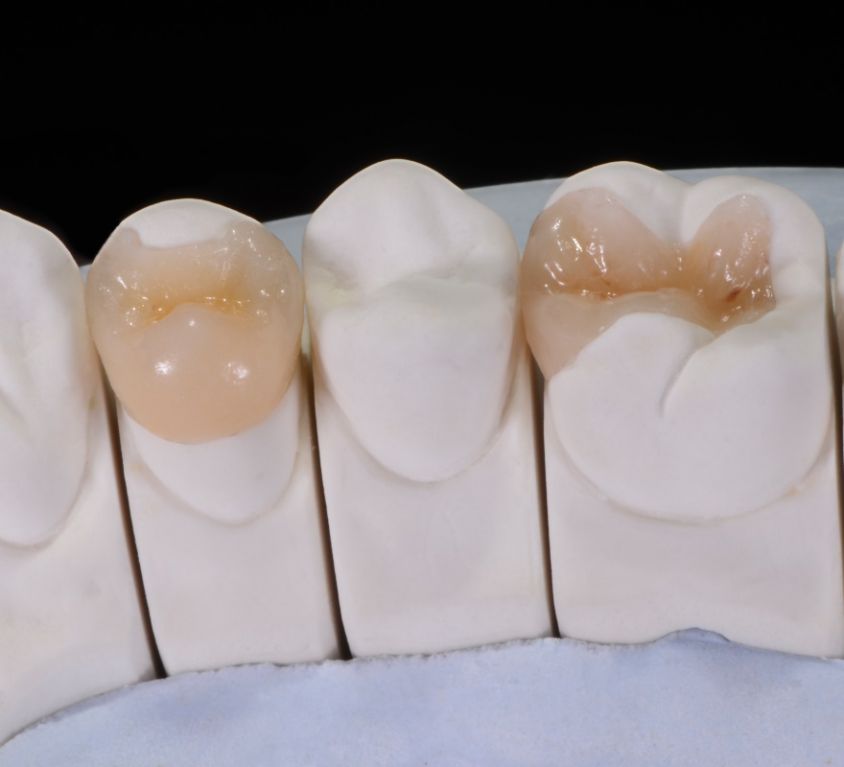 Partial crowns