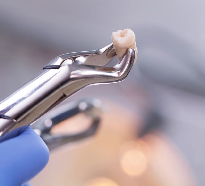 Tooth extraction