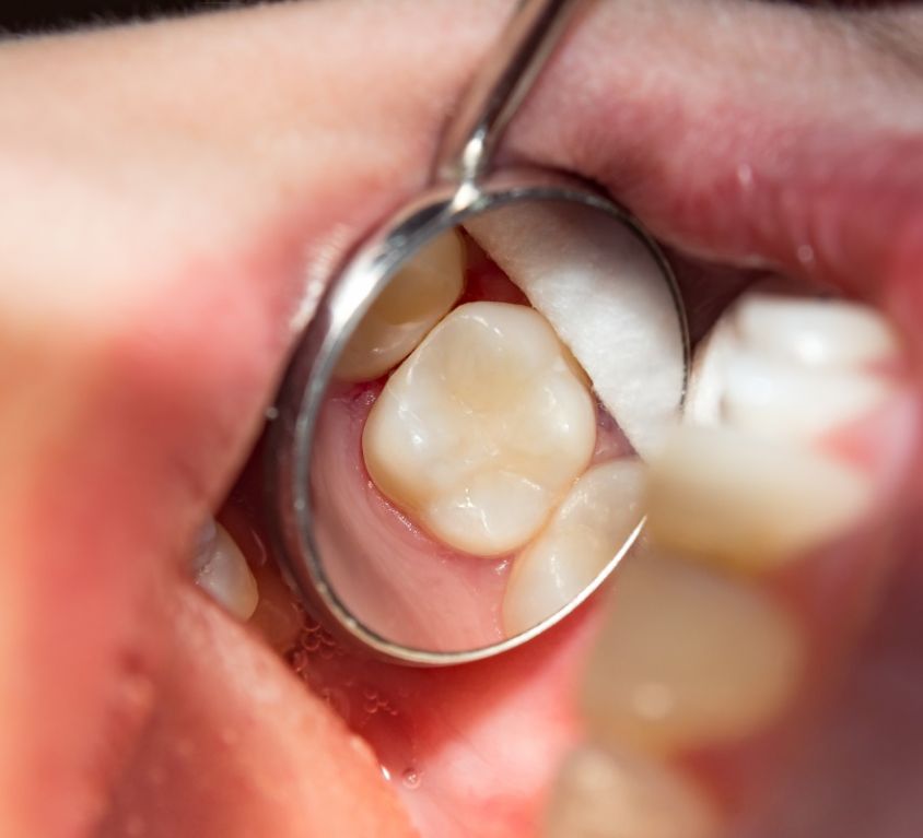 Dental Fillings