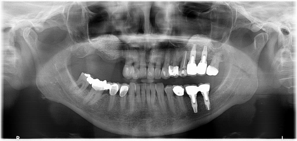Implantologie Röntgen