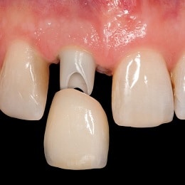 Dental crowns